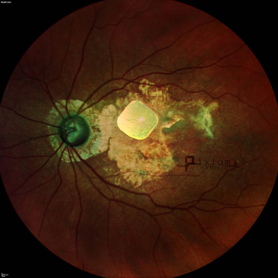 Bildquelle: Pixium Vision
